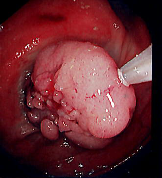 日帰りポリープ切除可能